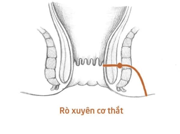 Điều trị rò hậu môn xuyên qua cơ thắt