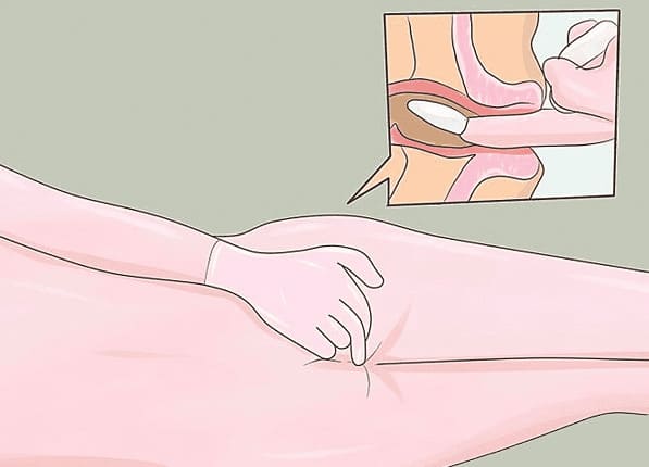 Thuốc nhét hậu môn bệnh trĩ