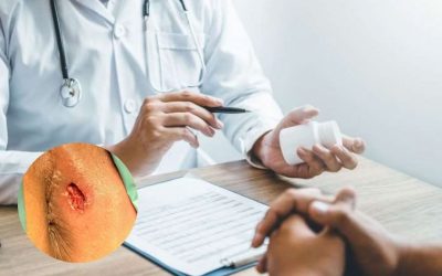 Cập nhật những loại thuốc trị apxe hậu môn không phải ai cũng biết!