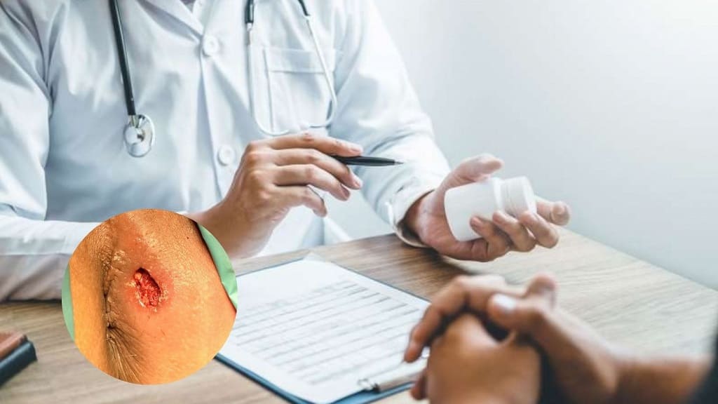 Cập nhật những loại thuốc trị apxe hậu môn không phải ai cũng biết!