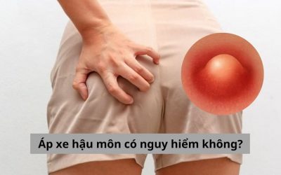 Góc giải đáp: Áp xe hậu môn có nguy hiểm không?