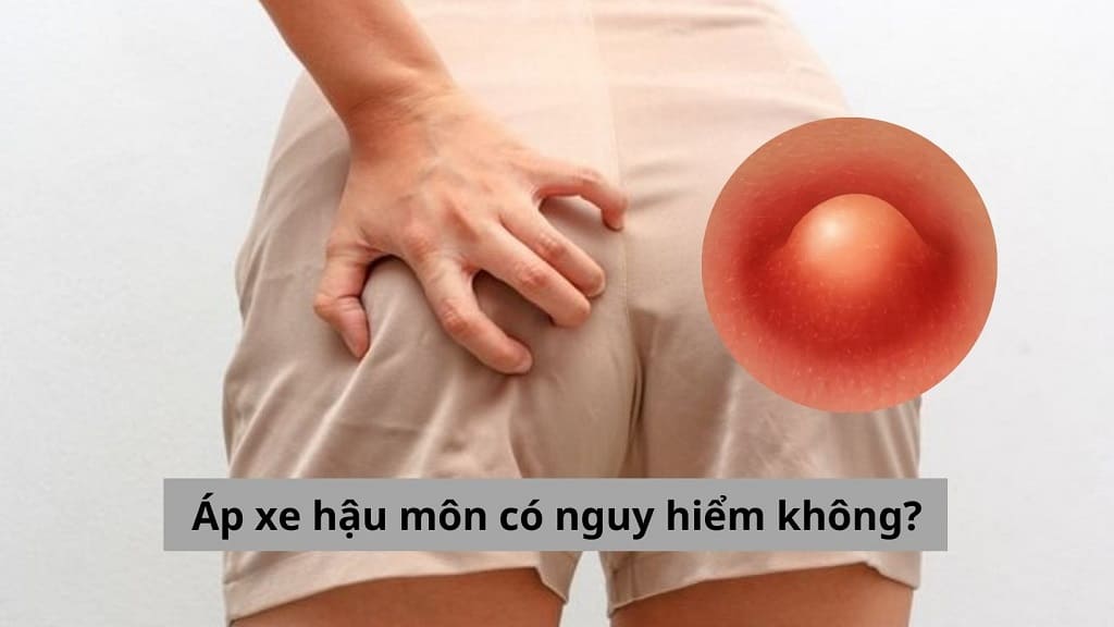 Góc giải đáp: Áp xe hậu môn có nguy hiểm không?