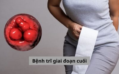 Tìm hiểu về mức độ nguy hiểm của bệnh trĩ giai đoạn cuối