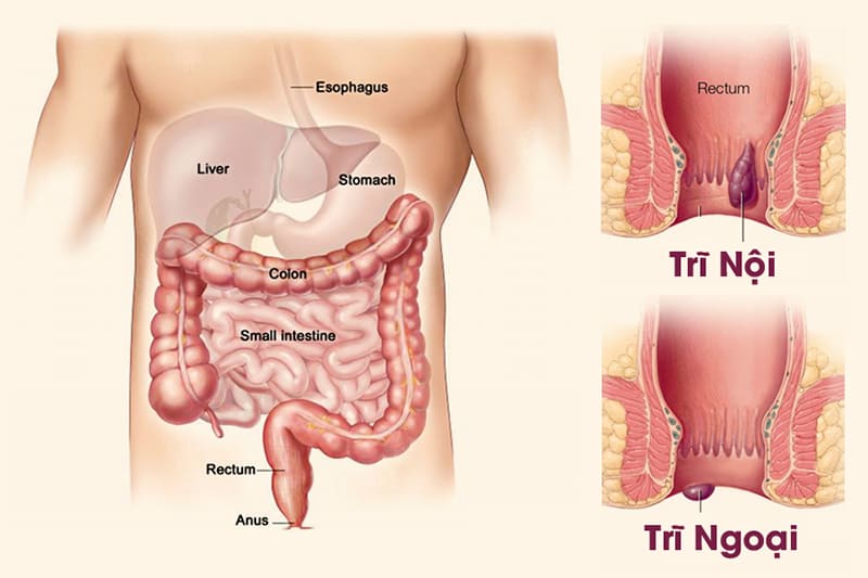 Nguyên nhân nào khiến bệnh trĩ hình thành?