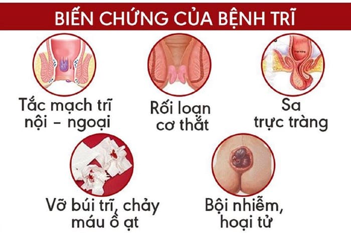 Biến chứng của bệnh trĩ