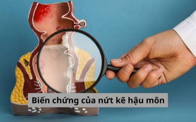 Biến chứng của nứt kẽ hậu môn và cách khắc phục hiệu quả