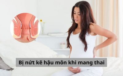 Bị nứt kẽ hậu môn khi mang thai: Nguyên nhân và cách khắc phục