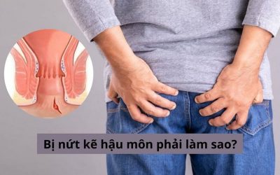 Bị nứt kẽ hậu môn phải làm sao để điều trị hiệu quả và an toàn