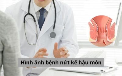 Cảnh báo từ hình ảnh bệnh nứt kẽ hậu môn, không nên chủ quan!