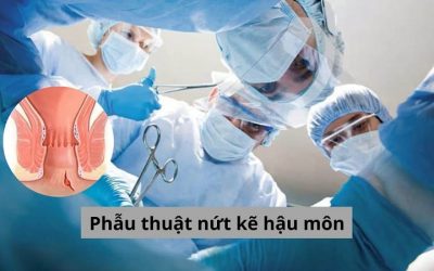Phẫu thuật nứt kẽ hậu môn và những thông tin bạn không nên bỏ lỡ