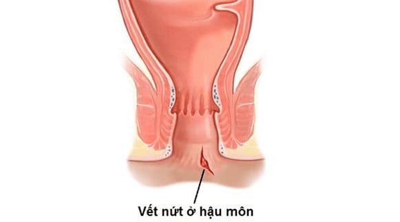 Bị nứt kẽ hậu môn khi mang thai có ảnh hưởng gì không? 