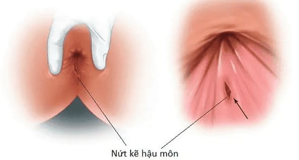 Bệnh nứt kẽ hậu môn