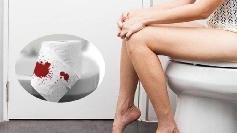 Biến chứng nứt kẽ hậu môn