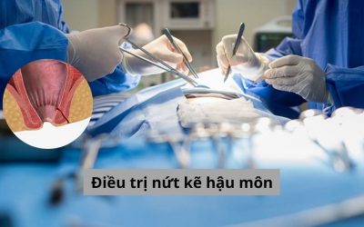 Điều trị nứt kẽ hậu môn bằng cách nào hiệu quả, chuẩn phác đồ