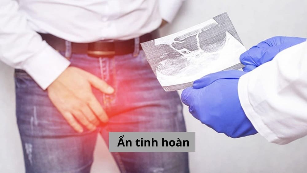 Tìm hiểu về bệnh ẩn tinh hoàn có gây vô sinh không?