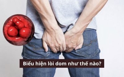 Biểu hiện lòi dom như thế nào? Top 3 triệu chứng phổ biến