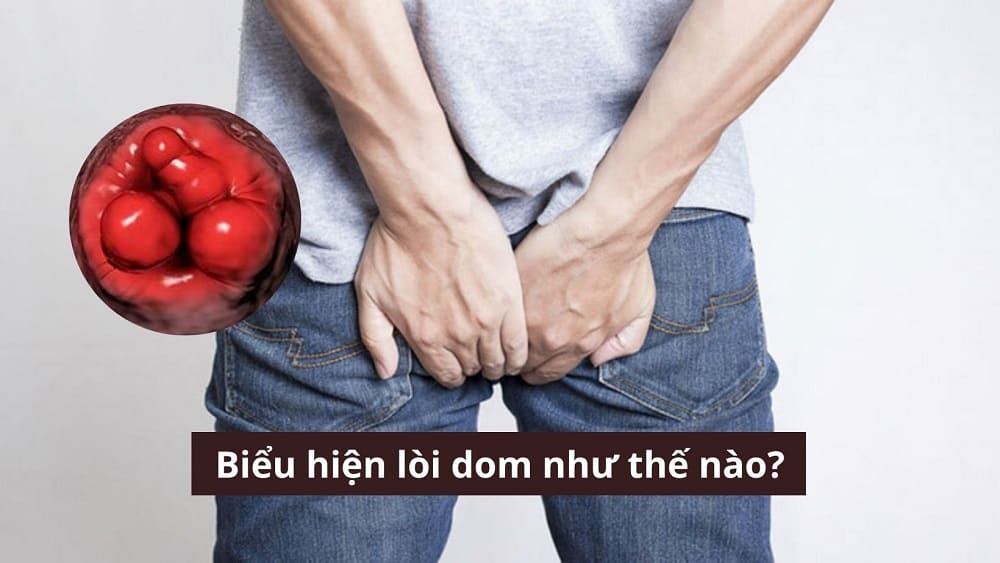 Biểu hiện lòi dom như thế nào? Top 3 triệu chứng phổ biến