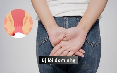 Bị lòi dom nhẹ là gì? Những cách chữa hiệu quả và đơn giản tại nhà 