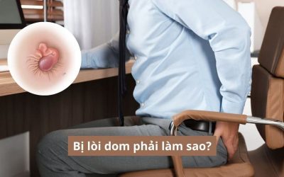 Bị lòi dom phải làm sao? Lời khuyên từ bác sĩ chuyên khoa 