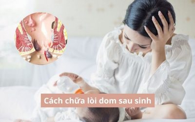 Cách chữa lòi dom sau sinh – Phương pháp nhanh chóng, hiệu quả?