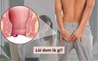 Tìm hiểu bệnh lòi dom là gì? Triệu chứng và cách điều trị lòi dom hiệu quả