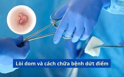 Bác sĩ giải đáp: Lòi dom và cách chữa bệnh dứt điểm