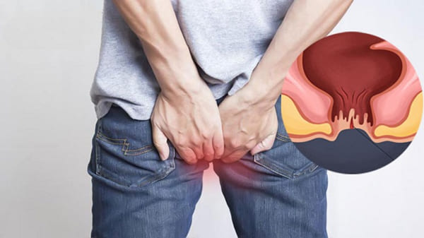 Liệu bệnh nứt kẽ hậu môn có nguy hiểm không?