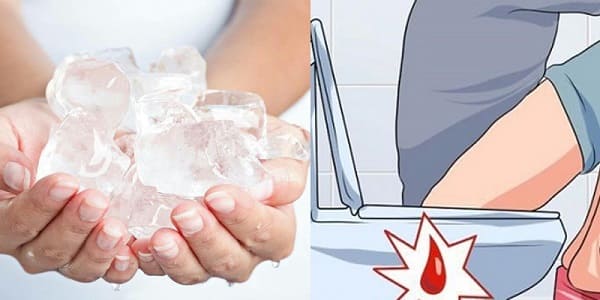 Chườm đá lạnh chữa lòi dom