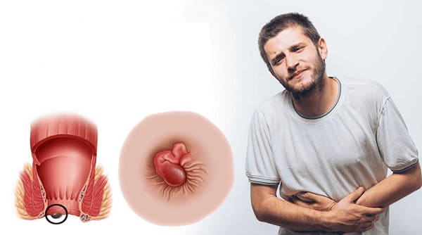 Cách nhận biết bệnh trĩ (lòi dom) 