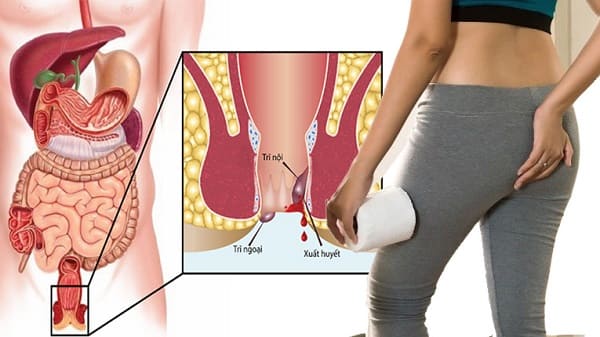 Biến chứng nguy hiểm nếu không điều trị lòi dom