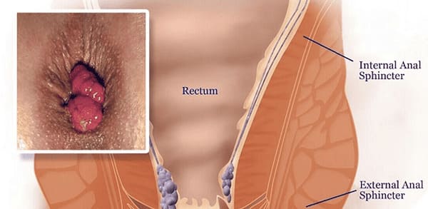 Bệnh trĩ biến chứng lòi dom có gì nguy hiểm?