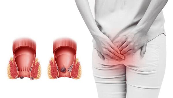 Lòi dom là bệnh lý như thế nào?