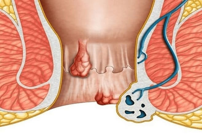 Phân loại bệnh lòi dom