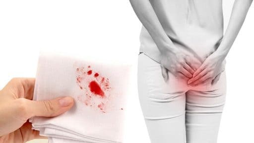 Các triệu chứng nhận biết bệnh lòi dom