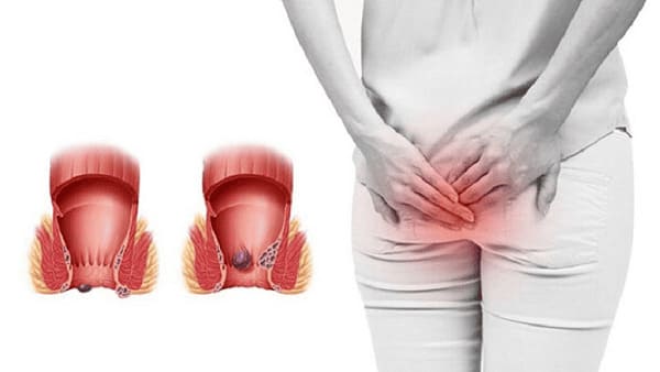 Bệnh lòi dom sau sinh là gì?
