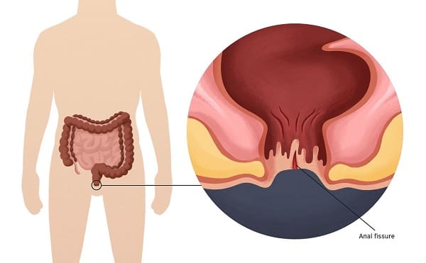 Một số cách chữa nứt kẽ hậu môn dùng nguyên liệu tự nhiên khác