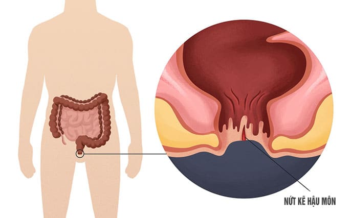 Chữa nứt kẽ hậu môn tại nhà có thực sự hiệu quả không?