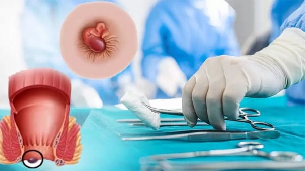 Điều trị lòi dom bằng phương pháp y khoa