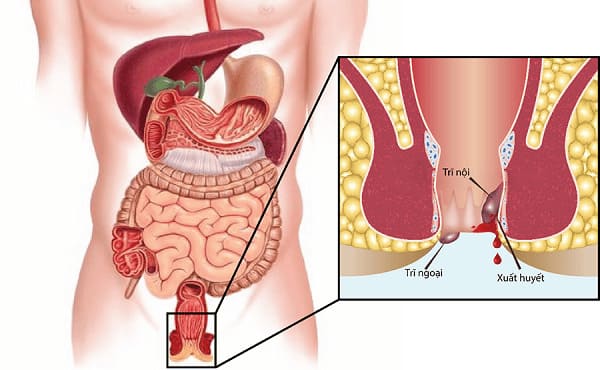 Lòi dom: Dấu hiệu và nguyên nhân 