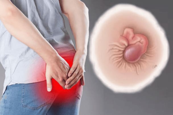Lòi dom khác trĩ như thế nào?