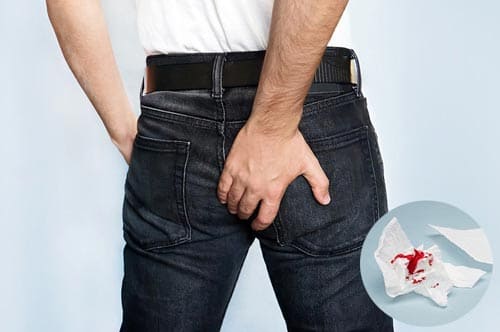 Triệu chứng nhận biết bệnh lòi dom