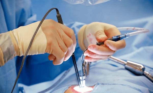 Phương pháp phẫu thuật lòi dom điển hình