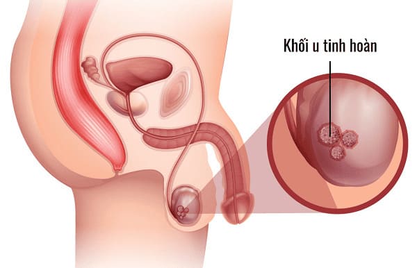 Giai đoạn phát hiện ung thư tinh hoàn