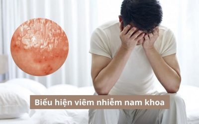 6 Biểu hiện viêm nhiễm nam khoa không nên chủ quan!