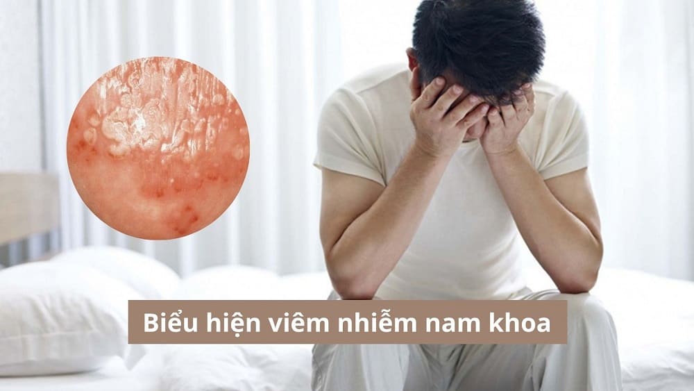 6 Biểu hiện viêm nhiễm nam khoa không nên chủ quan!
