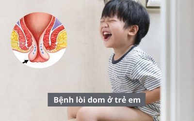 Bệnh lòi dom ở trẻ em (sa trực tràng) điều trị thế nào?