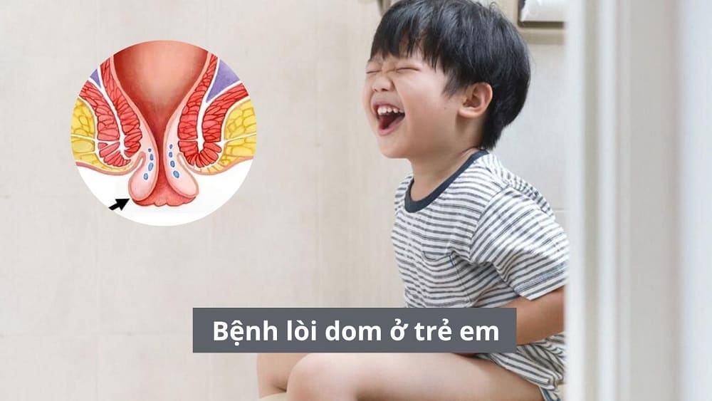 Bệnh lòi dom ở trẻ em (sa trực tràng) điều trị thế nào?