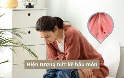 Hiện tượng nứt kẽ hậu môn: Đừng nhầm với vết xước thông thường!