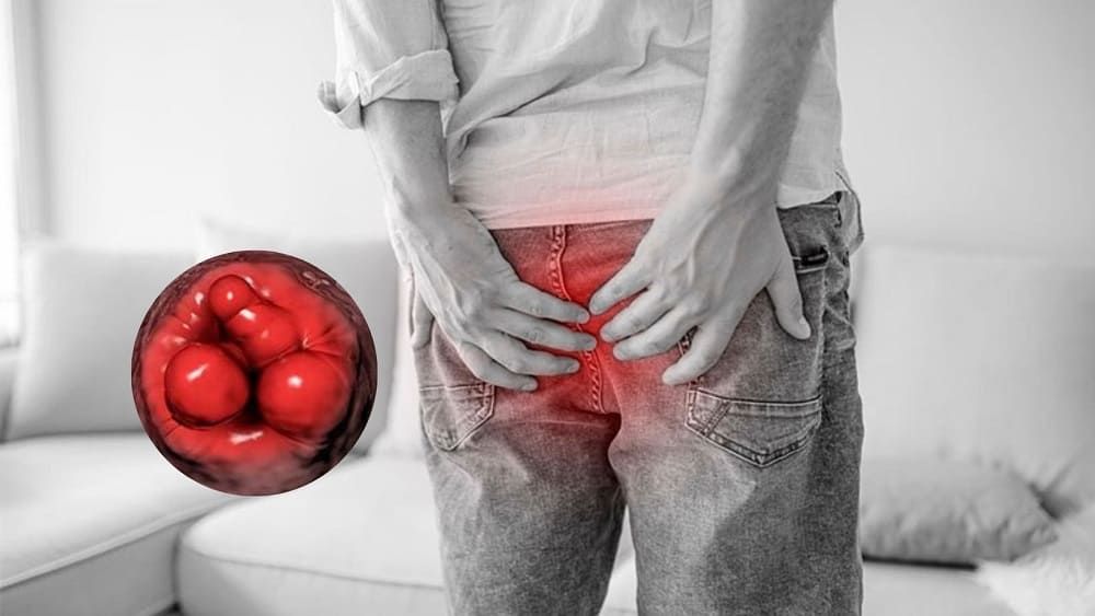 Cách chữa lòi dom ở hậu môn hiệu quả, hạn chế tái phát