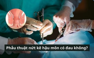 Phẫu thuật nứt kẽ hậu môn có đau không? Bao lâu thì lành?